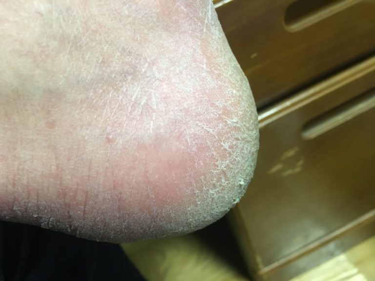 かかとが歩くと痛い-ガサガサ-角質